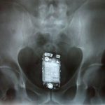 Doctor Leaves iPhone In Patient’s Abdomen; Patient Arrested For Theft