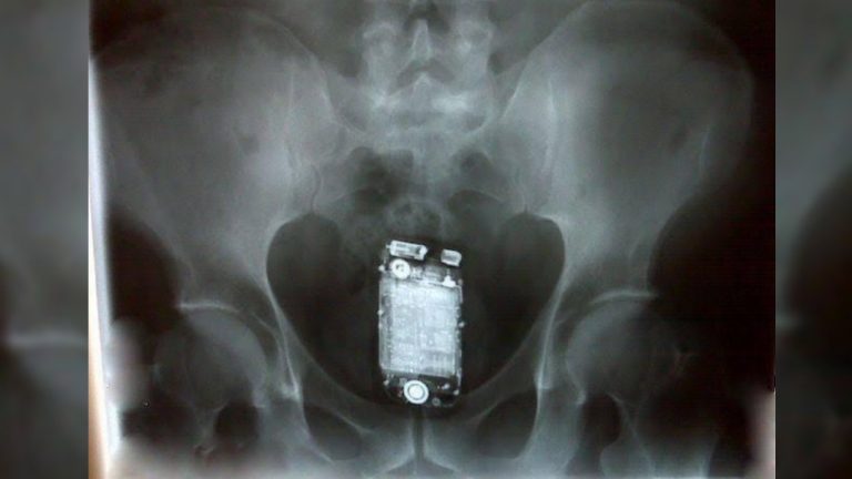 Doctor Leaves iPhone In Patient’s Abdomen; Patient Arrested For Theft